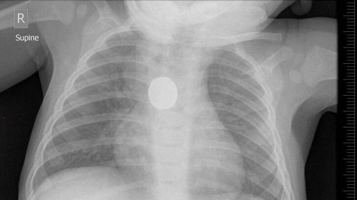 An x-ray showing a button battery lodged in the oesophagus of a 9-month-old boy. Photo: Supplied