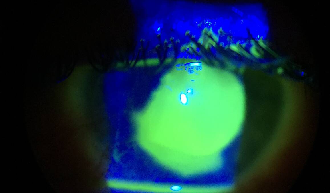 CLOSE UP: The green patch is where the skin layer (epithelium) has become inflamed and sloughed off from the front of the eye. Pain level is extreme and vision is poor.