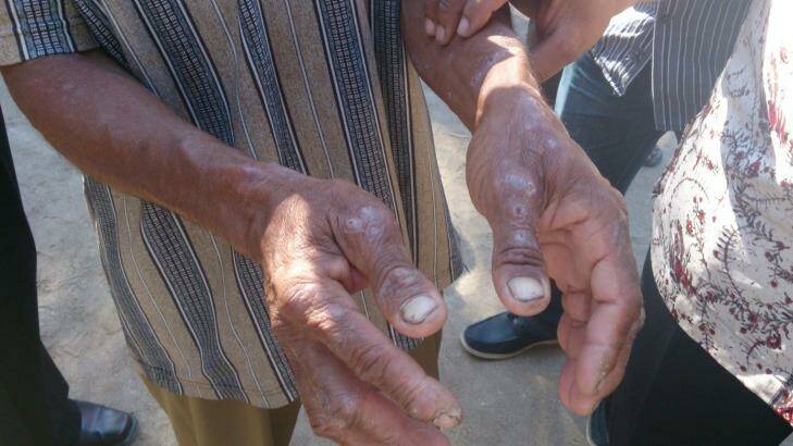 The hands of a man in Indonesia's East Nusa Tenggara province  in August 2013. People in the region complain of itchy skin conditions, possibly connected to the spill. Photo: Australian Lawyers Alliance