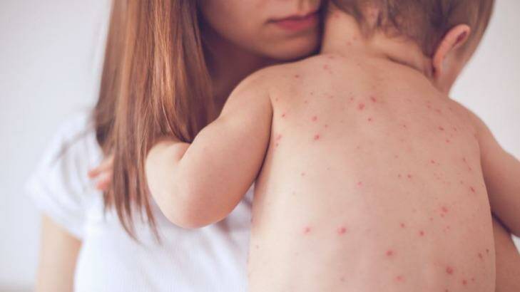 Four cases of measles have been confirmed in Brunswick and East Brunswick in the past week.