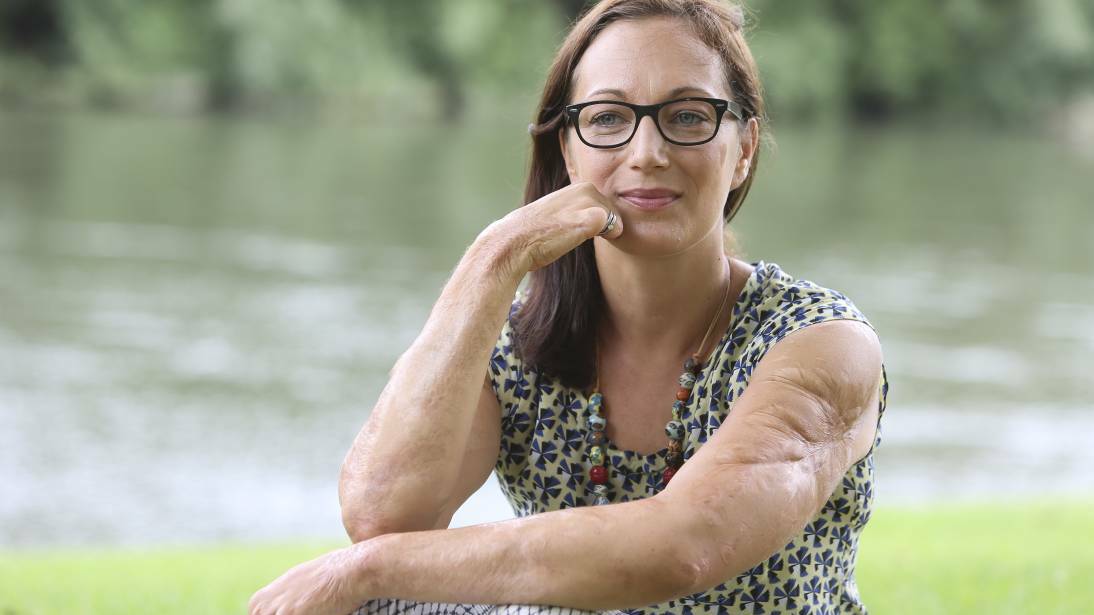 NEW DIRECTION: Surviving meningococcol forged a new path for Eliza Ault-Connell, who now raises awareness of the disease and is pushing for better prevention. Picture: ELENOR TEDENBORG