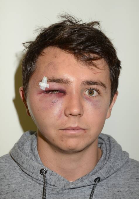 VICTIM: Jack Boehm's injuries the day after the road rage attack.