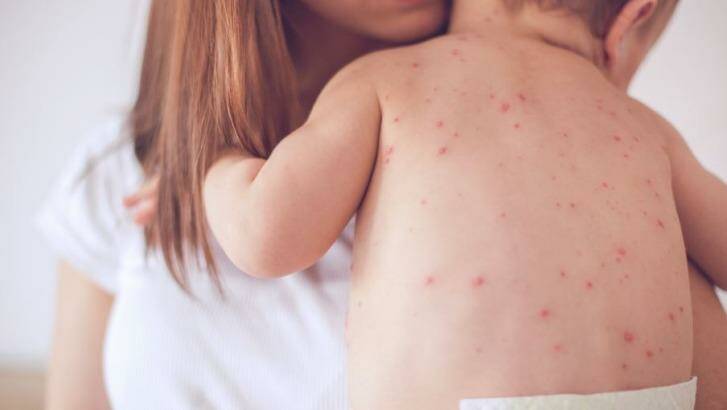 Baby with severe measles. Picture: file shot