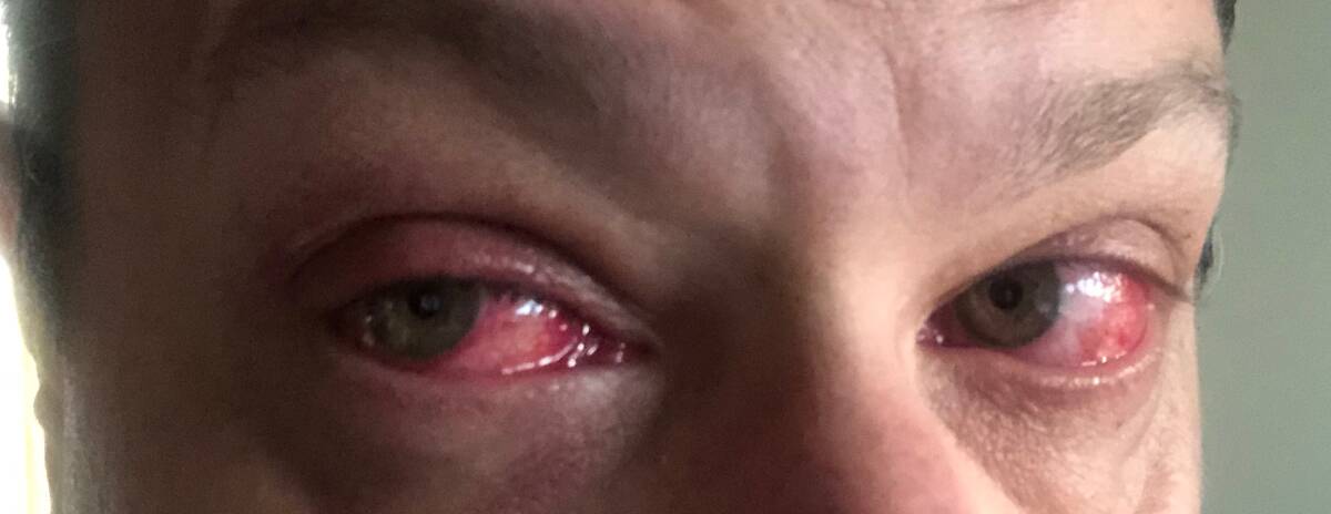 Most cases involve eye redness with varying degrees of swelling and ocular discharge, accompanied by clinical symptoms including pain, itching, and a foreign body sensation. One patient (pictured) has already taken part in the trial.