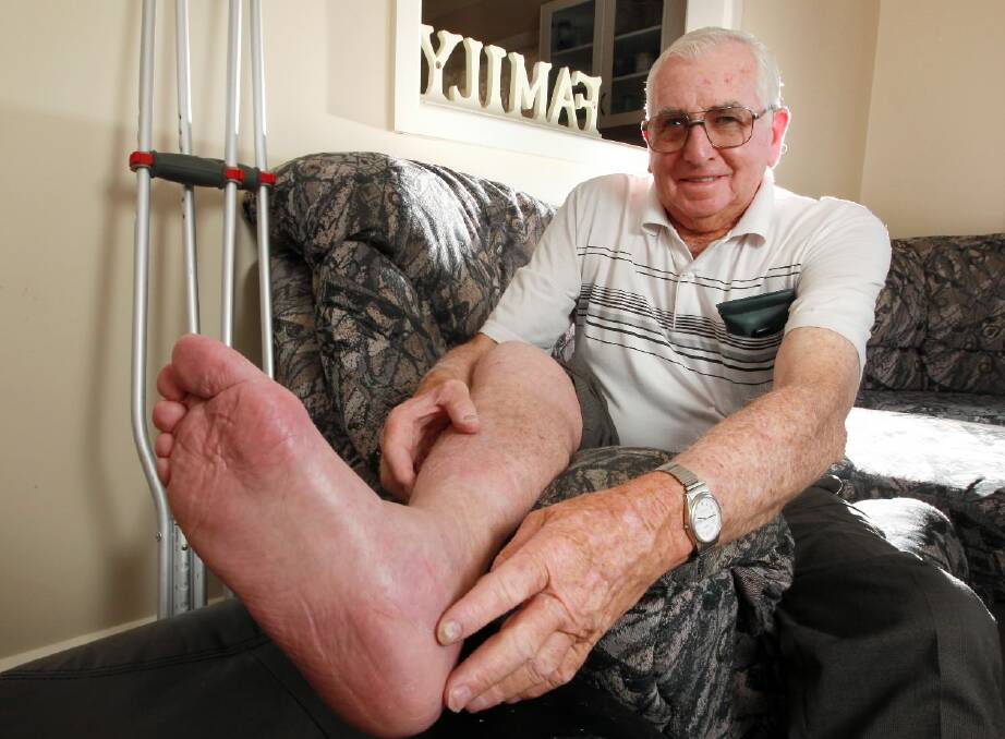 Len Chandler who is walking on a 3D printed titanium heel, show the good work done by his surgeon. Picture: KYLIE ESLER