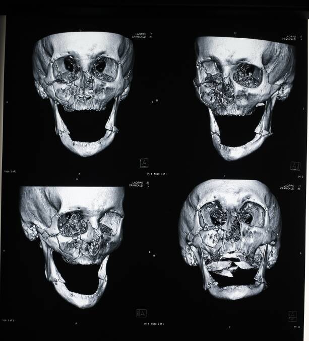 SHOCKING: X-rays of a man who suffered a fractured eye socket, nose and jaw from an attack in Albury in 2009.