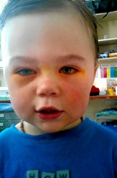 Hunter Wilmott, 2, who was suffering the painful condition Christmas Eye, on Monday.